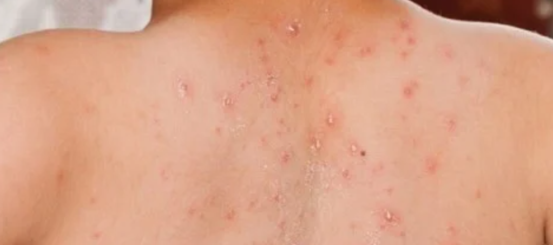 Lonjakan Kasus Campak, Pemkab Tasikmalaya Resmi Tetapkan Status KLB di Wilayahnya